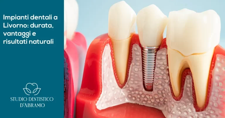 impianti dentali a livorno, durata vantaggi e risultati naturali e sicuri