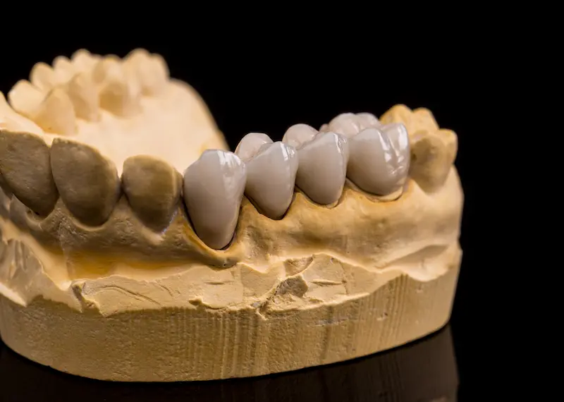 corone in ceramica o zirconia risultato estetico naturale